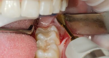 Nuovo protocollo estrattivo piezoelettrico nella chirurgia del dente del giudizio