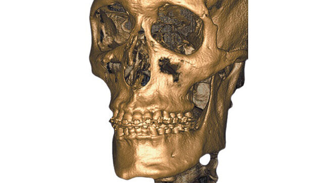 CBCT-Webinar: Voordelen van 3D Imaging integratie in uw praktijk