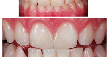 Restauraciones estéticas en la clínica diaria