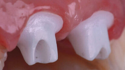 Le défi du remplacement d’incisives adjacentes