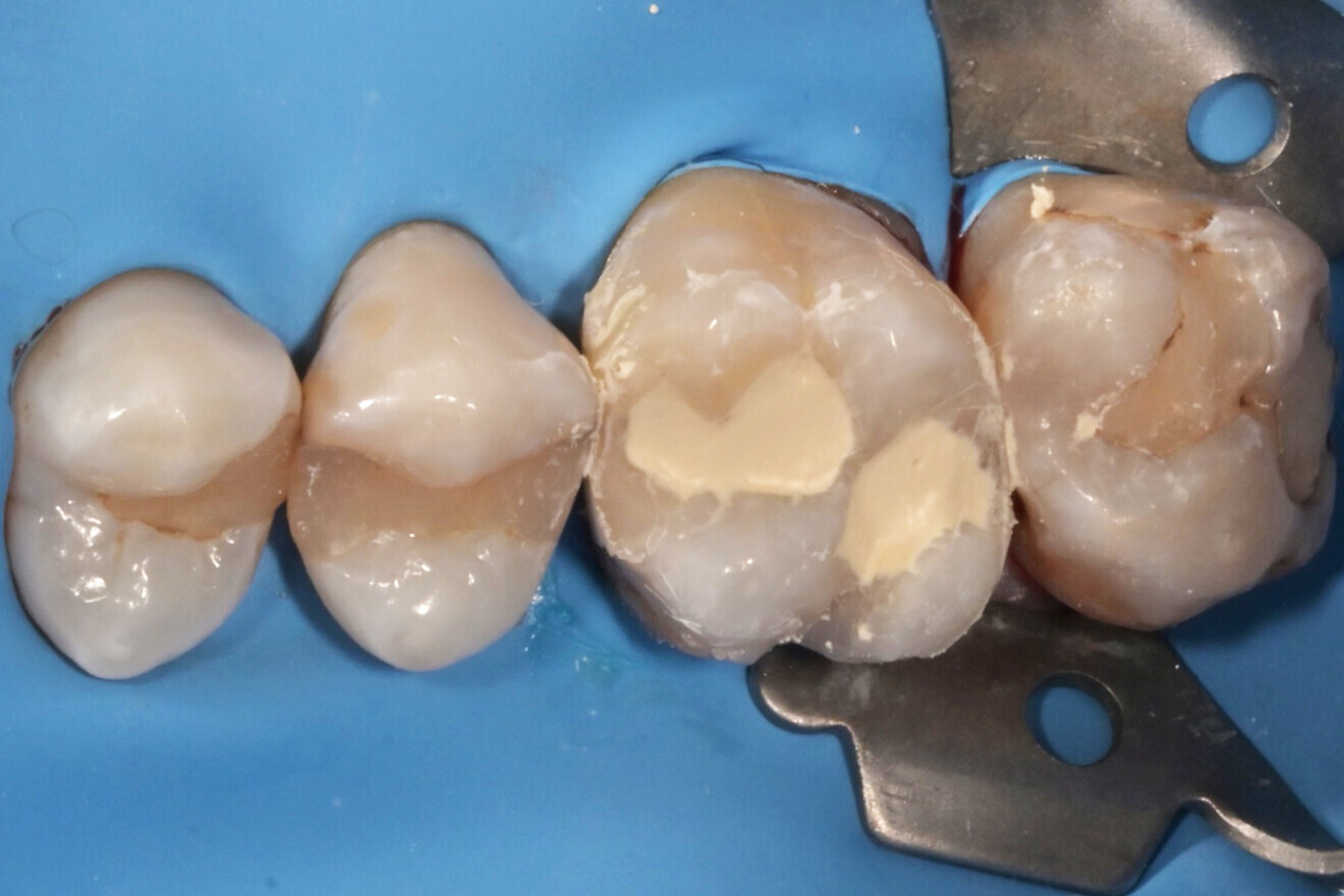 Фиг. 4: Запълване на останалия кавитет с Biodentine.