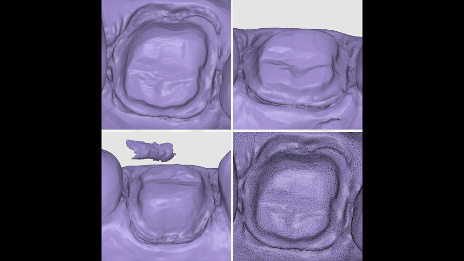 Fig. 8 - Scansione dei margini di preparazione con Medit i900.
