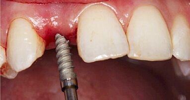 Optimising lateral incisor function and aesthetics with the Hahn Tapered Implant System