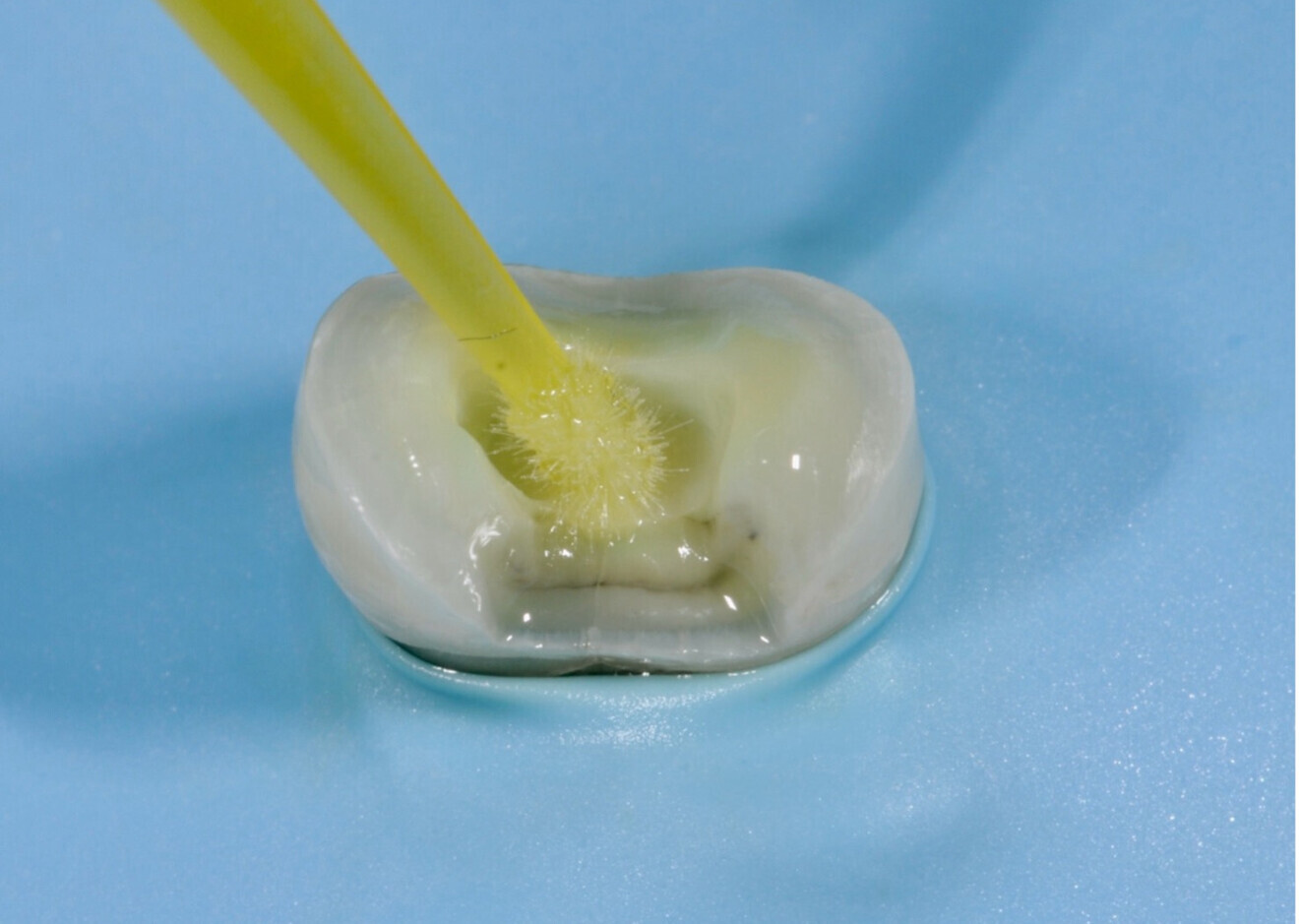 Fig. 3 : Mise en place de l’hybridation dentinaire (IDS) en zone prémolaire.