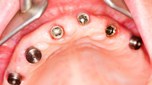 Оцеляването на денталните импланти при диабетици и здрави пациенти може да бъде еднакво успешно