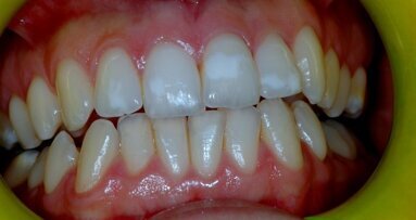 Manifestazioni orali nel paziente celiaco