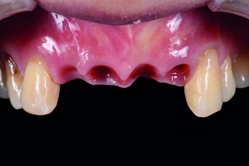 Fig. 28: Emergence profile after shaping by the provisional restoration.