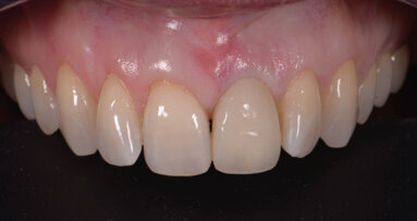 Remplacement d’une dent unitaire en zone esthétique : l’apport de la préservation alvéolaire pour un résultat final durable