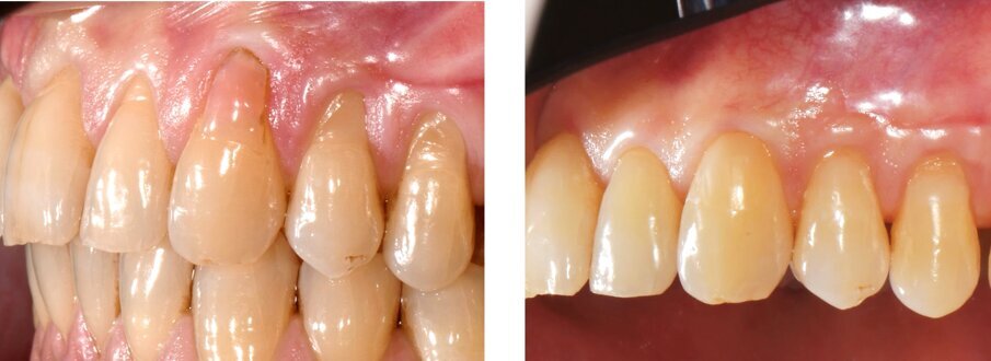 Figg. 9a, 9b - Particolare della guarigione in corrispondenza del 23. A sinistra la situazione iniziale, con la copertura in composito. A destra, ad 1 anno dalla chirurgia di ripristino della copertura radicolare.