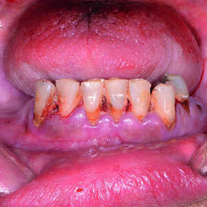 Fig-13-Arcade-mandibulaire-anesthésiée-300x300-