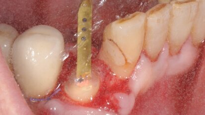 Impianto post-estrattivo e sua protesizzazione immediata. La tecnica di preparazione endo-alveolare del sito implantare con PIEZOSURGERY