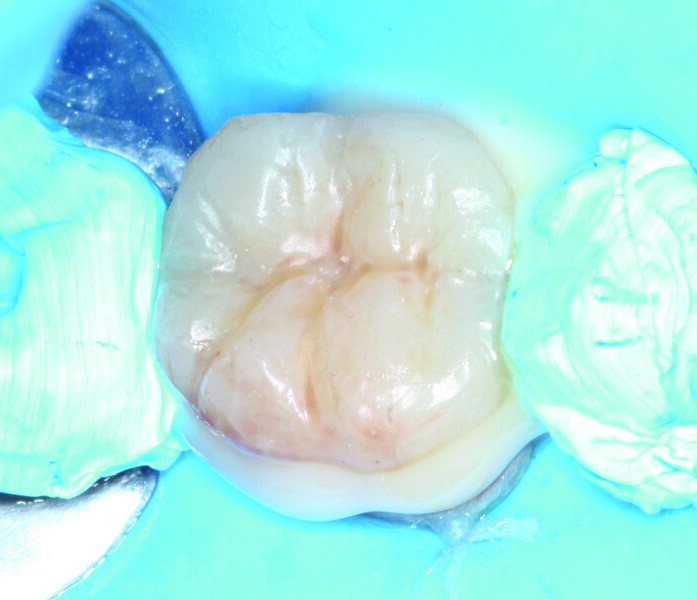 Fig. 14: Securing the endocrown by applying slight pressure allowed excess luting material to ooze out at the preparation margins.