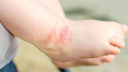 Crianças com dermatite atópica têm maior risco de cárie mais tarde na vida