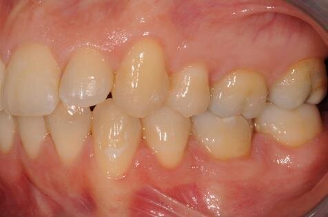 Figg. 2a-2c - Foto intraorali pretrattamento: visioni frontale (a), laterali (b).