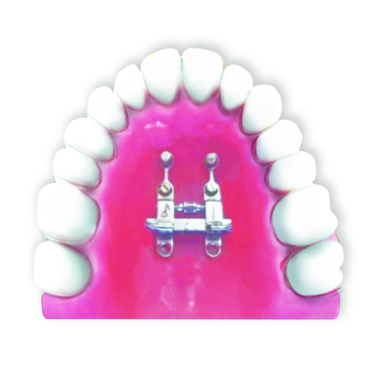 Fig.2 Bone-bone anchored designThe support arms can be temporarily bonded with composite to stabilize the expander for TAD insertion and cut off afterwards 