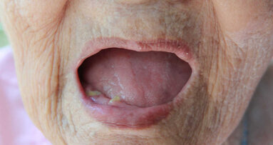 Badanie sugeruje związek przyczynowy między utratą zębów a chorobami serca