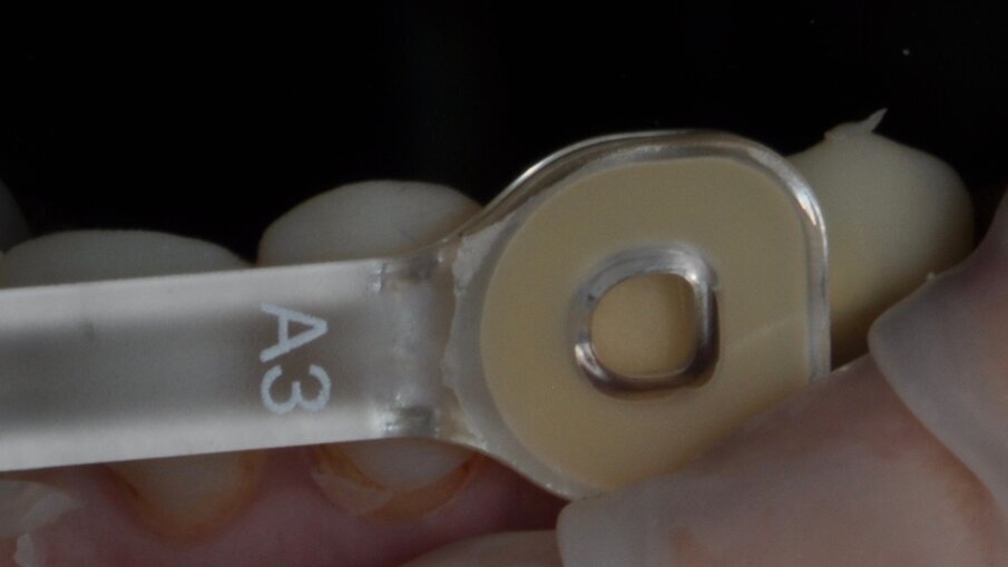 De kleurkeuze werd op voorhand bepaald aan de hand van de 3MTM Filtek Universal Restorative kleursleutels.