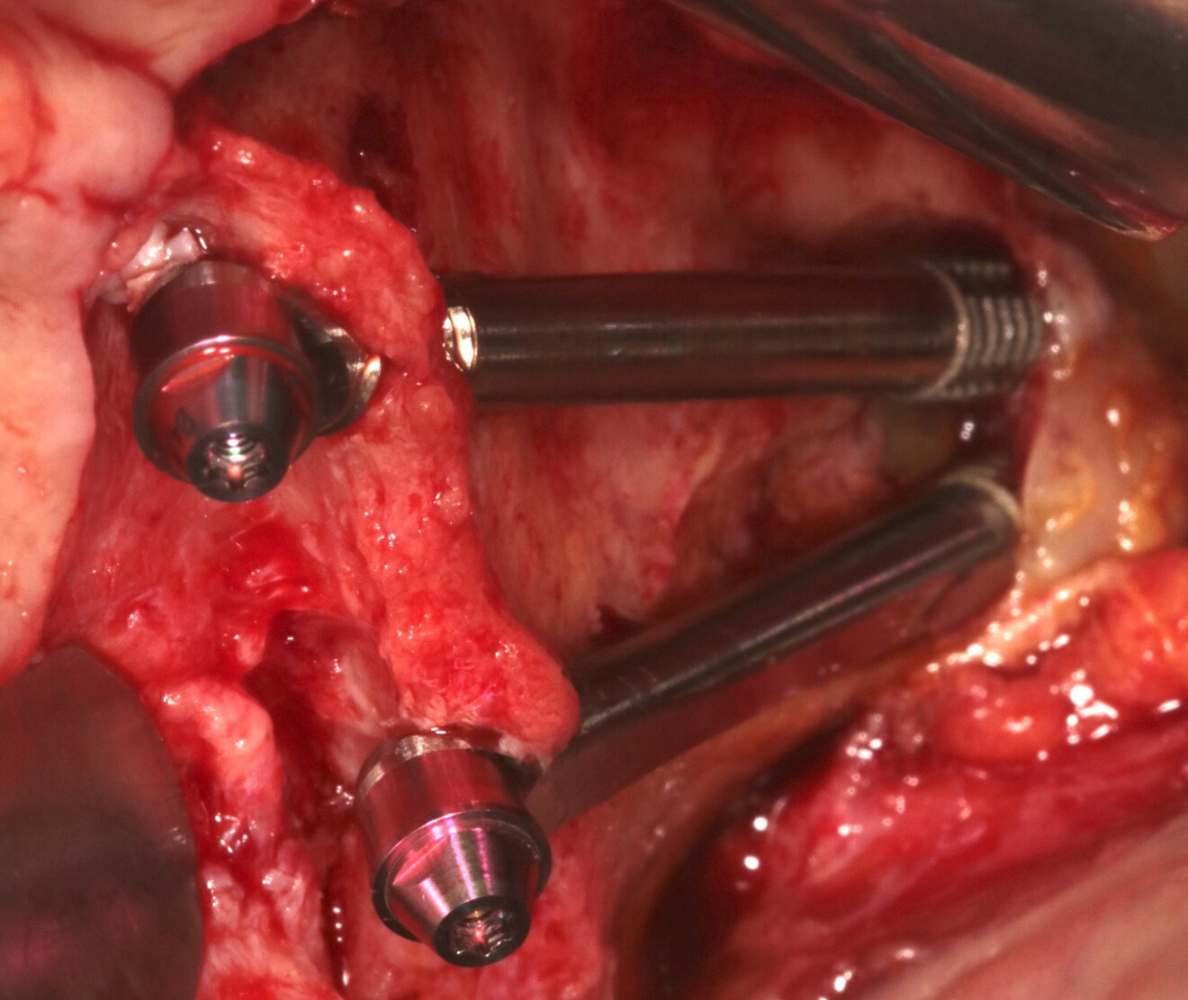 Fig. 1a : Photographie endobuccale de deux IZ.