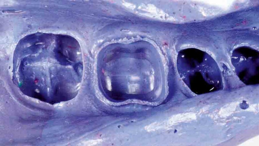 Fig. 7: Monophase impression taken with 3M™ Impregum™ Penta™ Soft Medium Body Polyether Impression Material. A very detailed representation of the preparation margin is obtained with this simple technique.