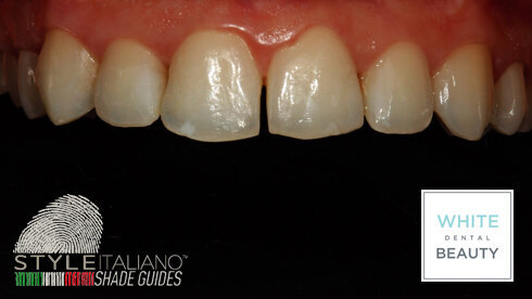 Situace před bělením