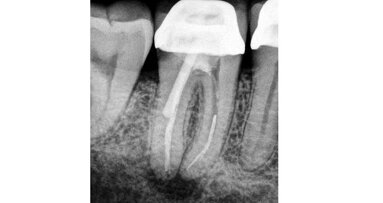 The lazy man’s guide to persistent apical periodontitis