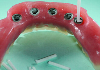 1-Bononia Implant System: O.T. Equator