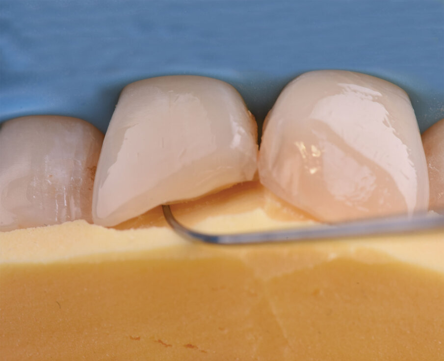 Sl. 8: Markiranje palatinalnog nivoa preparacije zuba  na silikonskom ključu