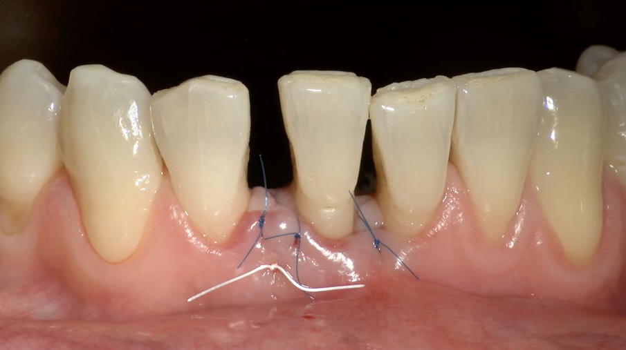 Fig. 6g - Lembo suturato.