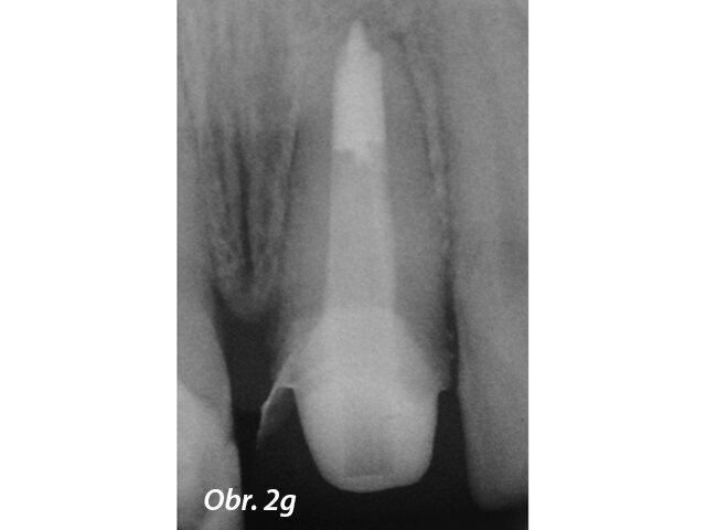 Postoperační RTG ukazuje výplň MTA a rekonstrukci se světlovodným čepem