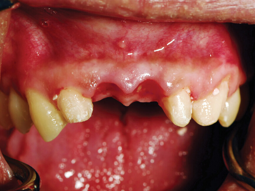 Fig. 6: Buccal view of the anterior maxilla demonstrating preservation of the papilla due to the provisional bridge. (Photo provided by Dr. Gregori M. Kurtzman)