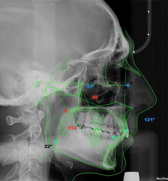 Fig. 29: McNamara cephalometric analysis four years after treatment (image generated using NemoCeph Studio).