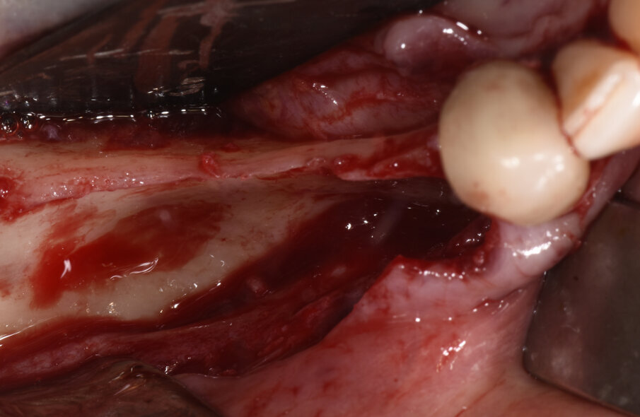 Fig. 3_Visione intra-operatoria dopo l’allestimento di un lembo a tutto spessore che evidenzia il difetto osseo.