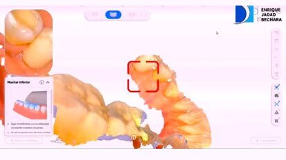 Demostración de las funciones de un escáner intraoral