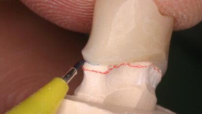 La validazione clinica dei prototipi in protesi fissa in ambiente digitale CAD/CAM