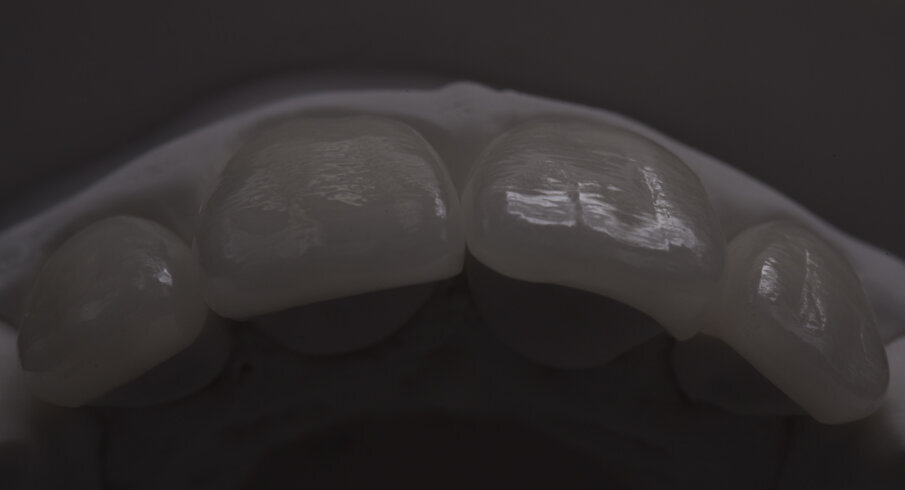 Fig. 19: Definitive restoration with all the texture details on the plaster model.