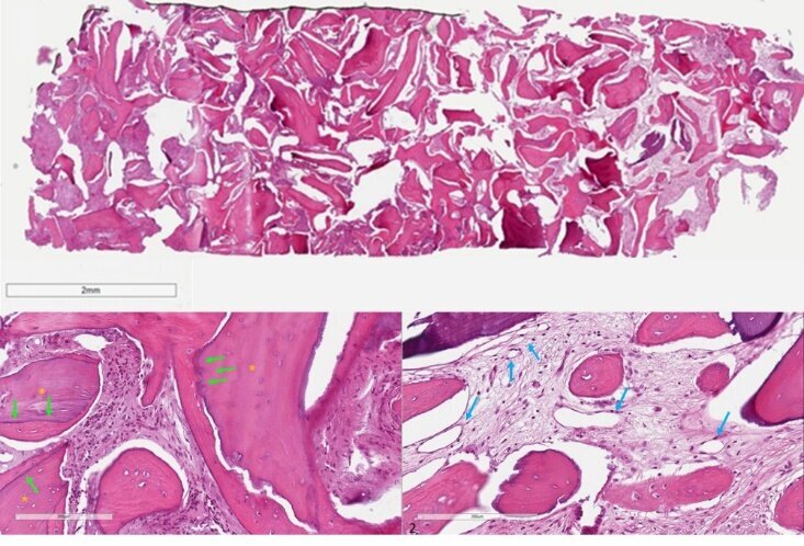 Fig. 9 - Analisi istologica. Le sezioni ossee complete (in alto) appaiono composte di tessuto osseo di nuova formazione, compreso tessuto di tipo osteoide, nonché di particelle biomateriale residuo. L’analisi a maggiore ingrandimento mostra (sinistra) granuli di biomateriale (asterischi gialli) inglobati da tessuto osseo neoformato ben osteointegrati nella matrice calcificata, con cui sono in contatto senza evidenza di gap (frecce verdi). Gli spazi midollari (destra) sono caratterizzati dalla presenza di numerosi vasi sanguigni (frecce blu).