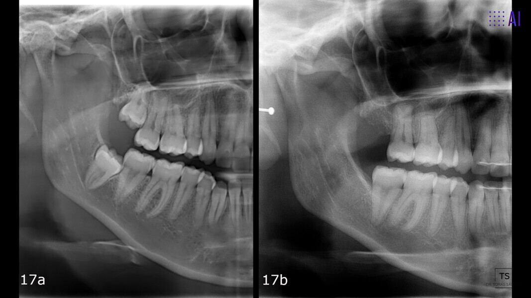 Figs. 17a & b: Comparison between the (a) initial and (b) final dental panoramic tomograms, depicting the extent of distalisation of tooth #47.