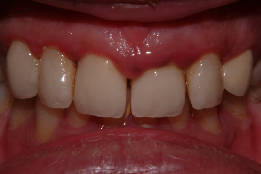      Fig 1. A significant inflammatory        response, with bone loss in a poorly controlled diabetic