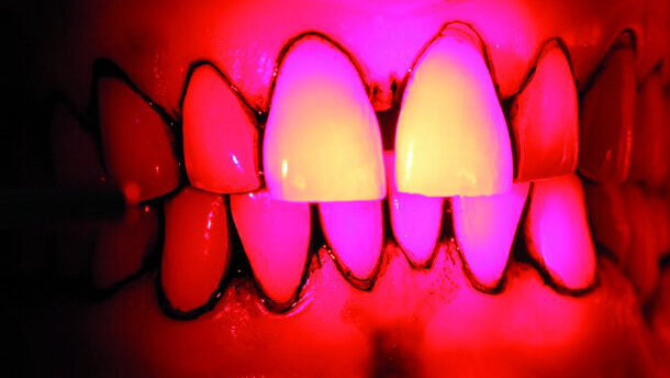 Parodontites et traitements laser