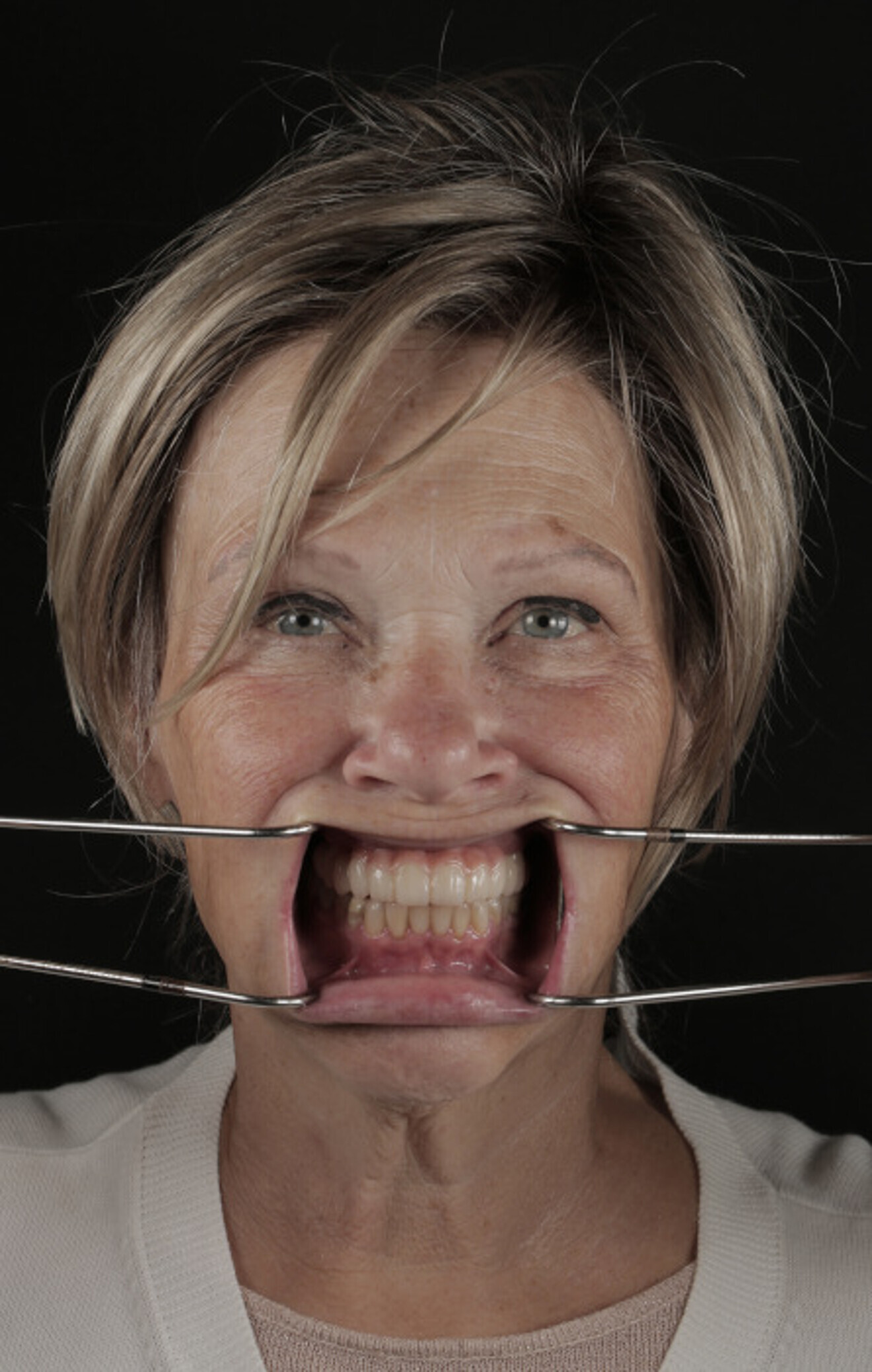 Fig. 20b: Provisional prosthesis after design modification.