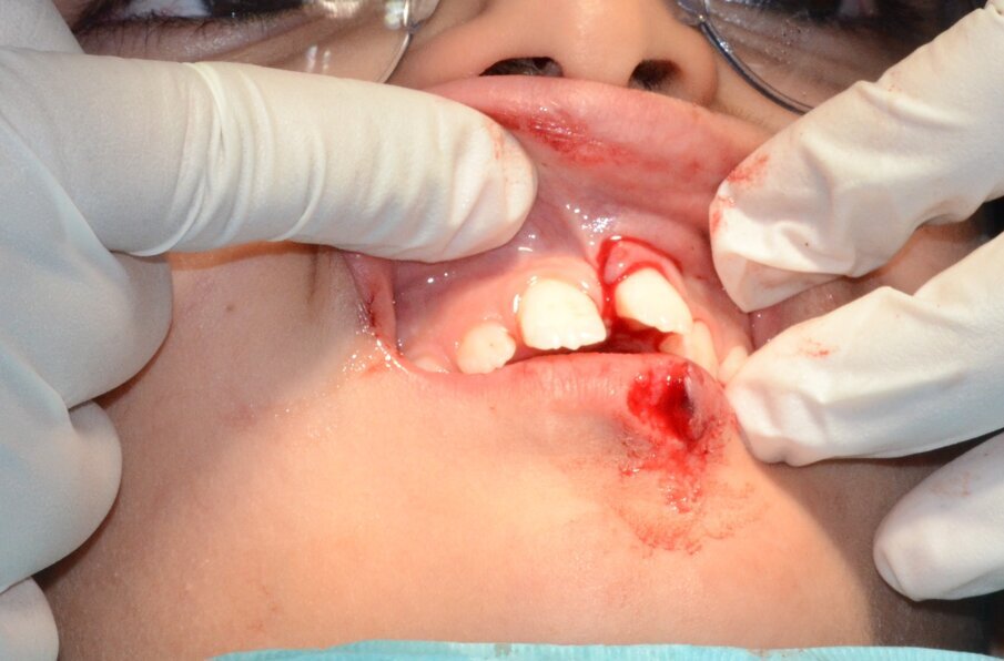 Figure 6: Tooth 21 was replanted gently into the socket after giving LA.  This took place 60 minutes after the injury