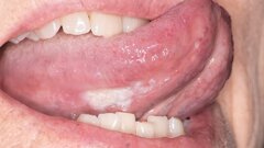 Un ensayo clínico frena lesiones orales precancerosas