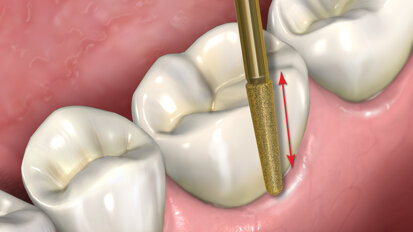 Fig. 2: The diamond-coated bur is held against the buccal surface of the crown with light pressure and moved in a direction that is parallel to the long axis of the diamond-coated bur to create a slot through the ceramic.