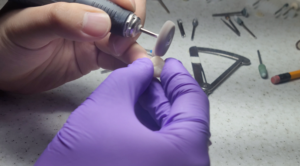 Fig. 11: Finishing and polishing of the 3D-printed crown using rotary instruments.