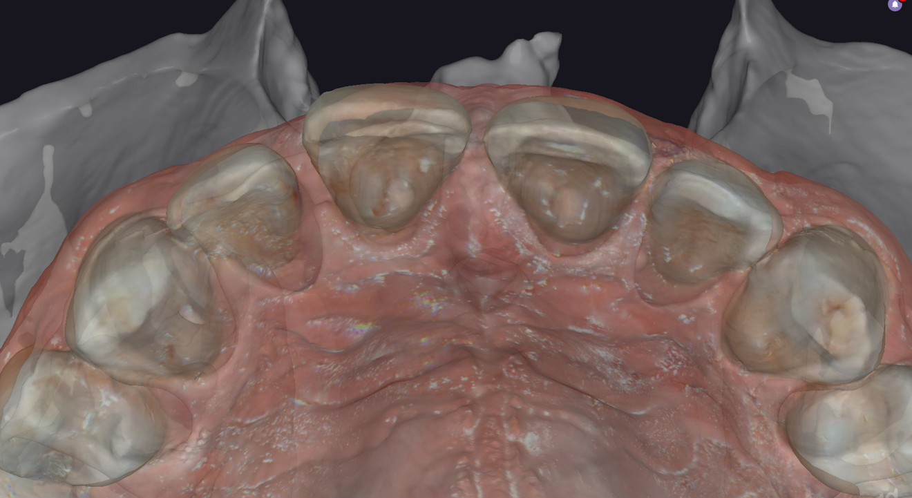 Fig. 3: Pre-op intra-oral image during planning with exoplan, palatal view.