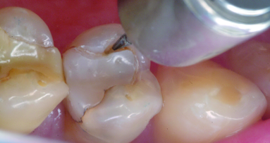 The perimeter preparation