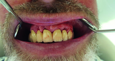 Trattamento efficace per la parodontite e la perimplantite con l’innovativa tecnologia a ossigeno