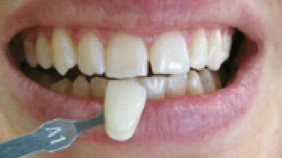 TouchWhite – příští generace v bělení zubů