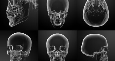 La modellazione 3D in chirurgia maxillo-facciale: intervista a Guglielmo Ramieri