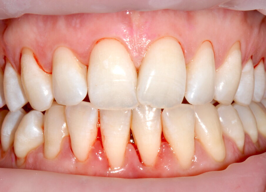 Figg. 4a-4f - Confronto fra inizio e termine della terapia. Le immagini (4a-c) mostrano le aree vestibolare palatale e linguale prima della terapia, mentre le immagini (4d-f) mostrano le aree vestibolare palatale e linguale dopo della terapia.